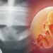 Menjamurnya Aborsi: Hilangnya Fitrah Perempuan Sebagai Rahim Kehidupan